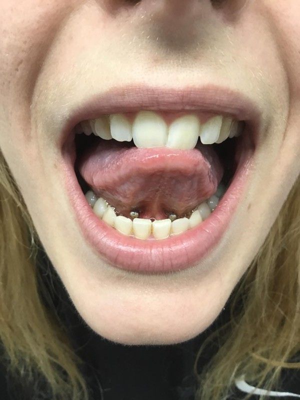 Piercing frenillo lengua
